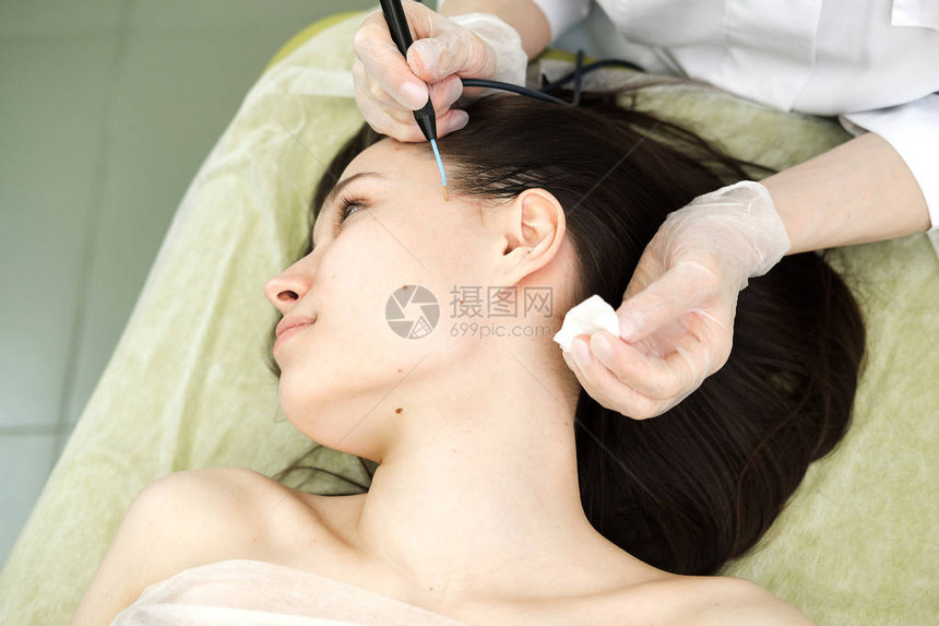 从女患者的脸上去除胎记的医学治疗使用专业电烙器去除痣的女皮肤科医生无线电图片