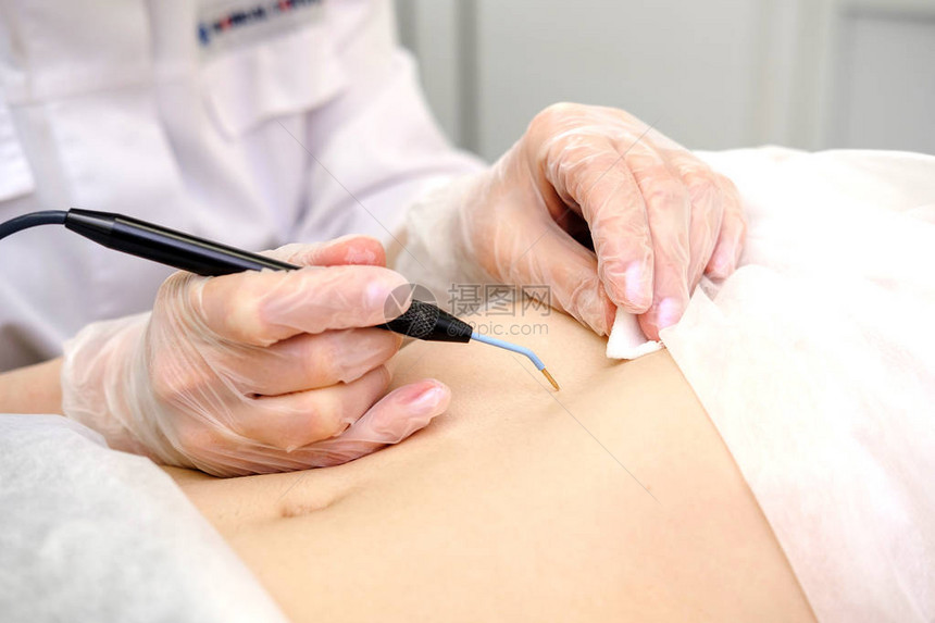 从女患者的胃中去除胎记的医学治疗女皮肤科医生使用电烙术去除腹部痣无线电图片