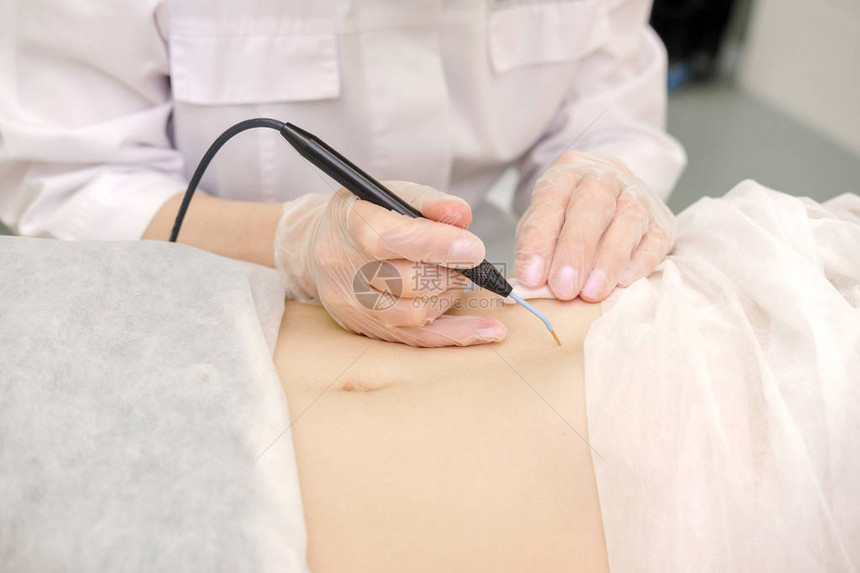 从女患者的胃中去除胎记的医学治疗女皮肤科医生使用电烙术去除腹部痣无线电图片