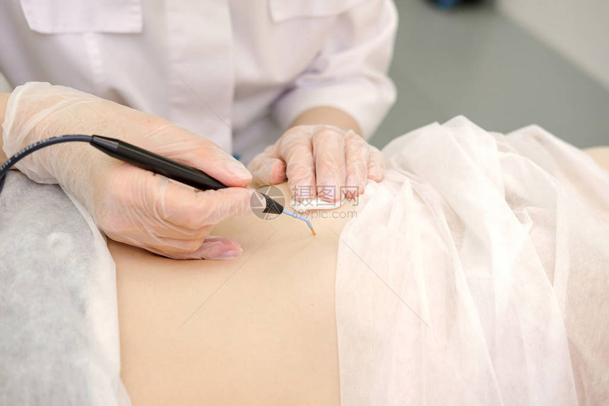 从女患者的胃中去除胎记的医学治疗女皮肤科医生使用电烙术去除腹部痣无线电图片