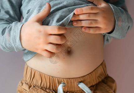 水痘宝孩子身上的水痘带状疱疹或疥疮皮肤病学的概念宝的肚子上有斑点特写抓背景图片