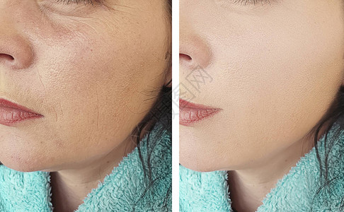 女在美容手术前后脸上的皱纹图片