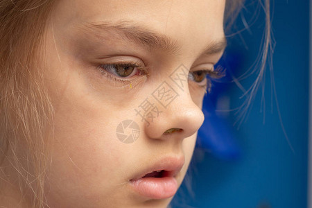 生病的孩子眼睛结膜炎图片