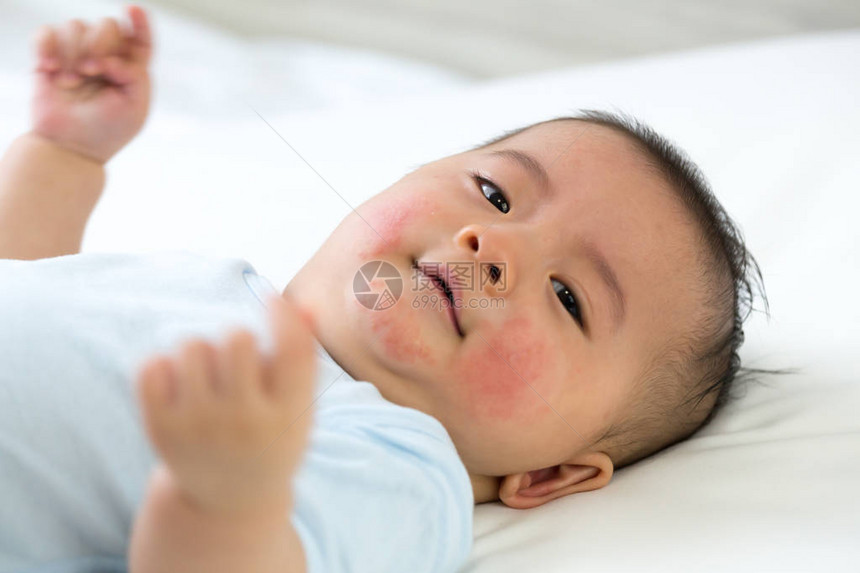婴儿对脸有过敏反应婴儿图片