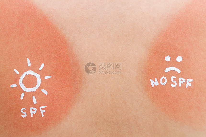 太阳形状的近视透镜是用遮晒油在妇女背部被烧焦的皮肤上绘制的图片