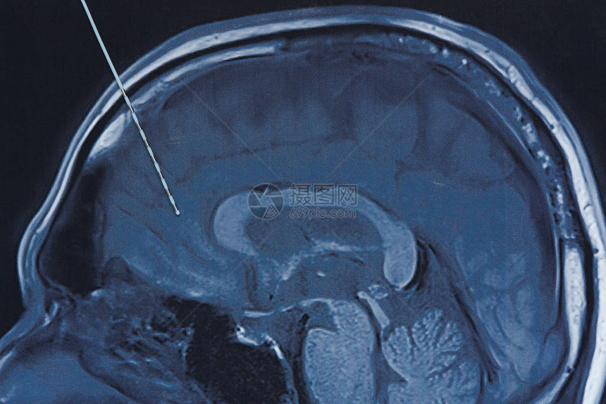 在癫痫手术中使用深度电极记录脑电波的概念脑MRI成像图片