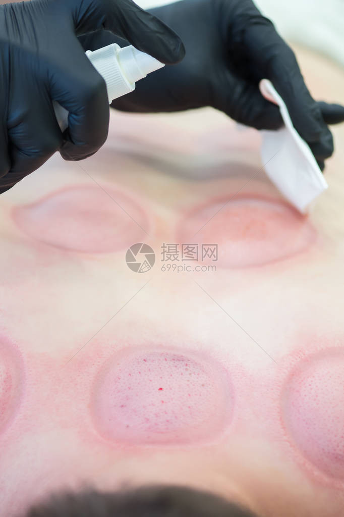 Hijama处理流血问题清理图片