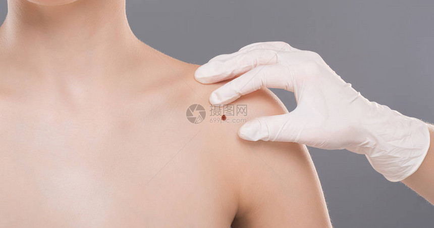 皮肤科医生检查妇女肩上的胎记闭合癌症预防图片