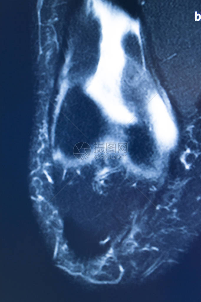 膝部运动受伤米克2级撕裂磁共振成像矫图片
