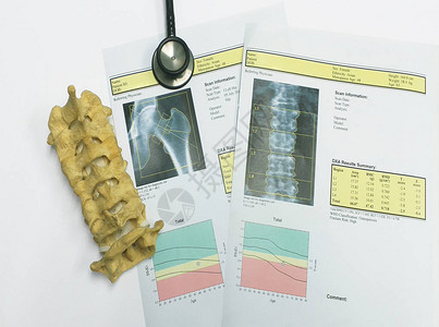 顶视图骨密度和腰椎结果骨质疏松症骨质疏松症是一种削弱骨骼的情况图片