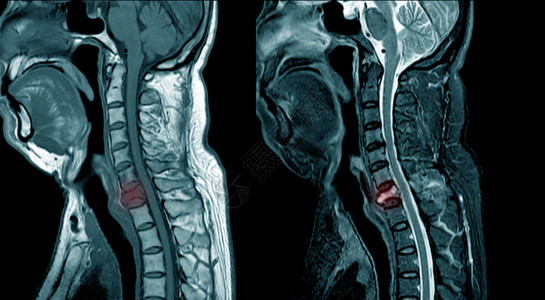 C7宫颈脊椎软组织质量和中度病理压缩图片
