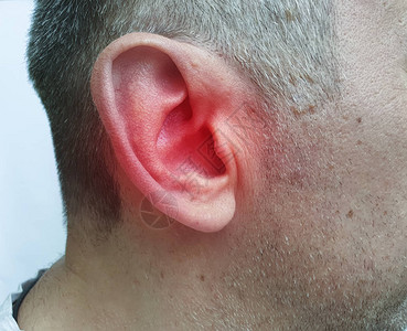 人伤他的耳朵是疾病的症状图片