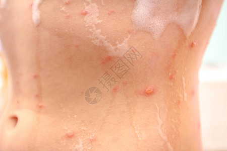 受天花感染的儿童皮肤正在使用抗消毒图片