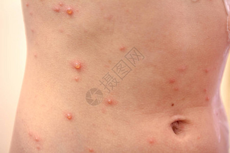 患有虫的儿童有麻疹天花风疹等疾病图片