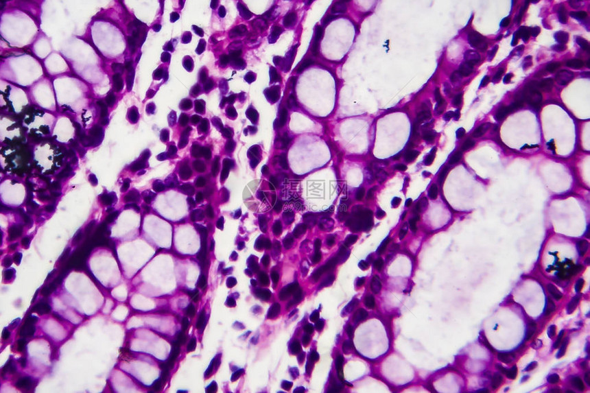 显微镜下的照片显示细菌的存在和炎症细胞的图片