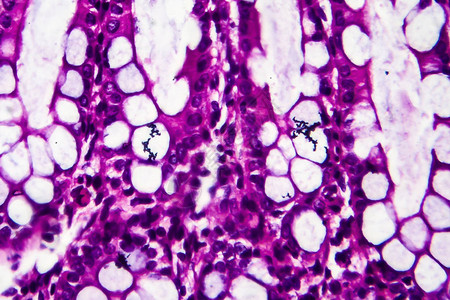 显微镜下的照片显示细菌的存在和炎症细胞的图片