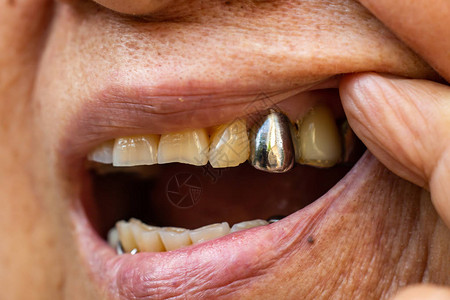 高级女口腔中的银金属人造牙口腔科和假牙套概念特写和宏观拍摄图片