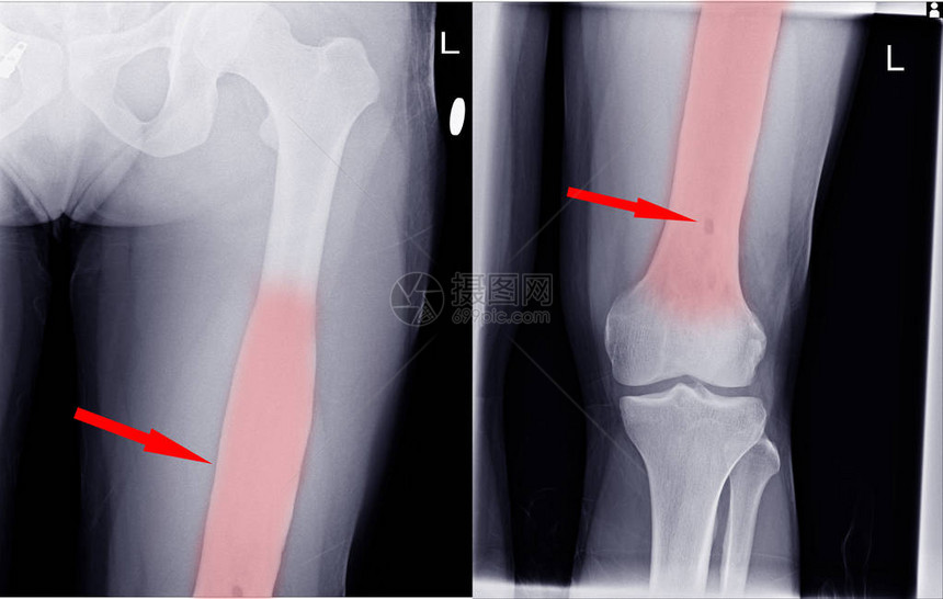 Knee关节Small淋巴病图片