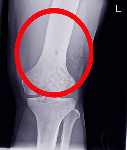 慢性化脓性骨髓炎Knee关节Small淋巴病背景