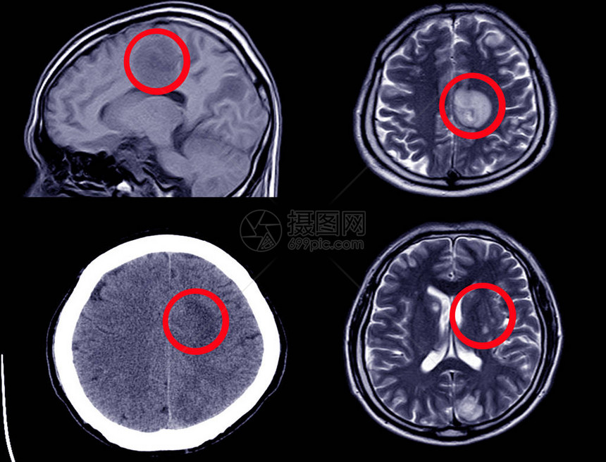 CT脑部显示追踪出血或质量的CT扫描和M图片
