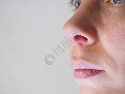 女人鼻子下面的疱疹闭上图片