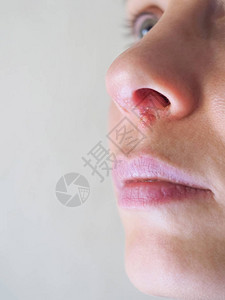 鼻子下面的疱疹特写图片