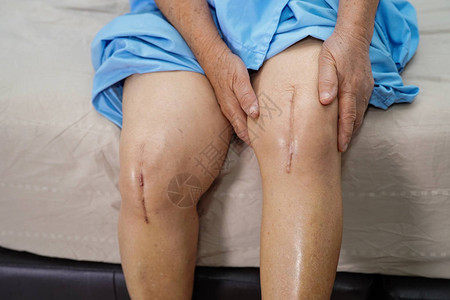 亚洲老年或老年妇人患者在护理医院病房的床上展示她的疤痕手术全膝关节置换缝合伤口手术关节成形术背景图片