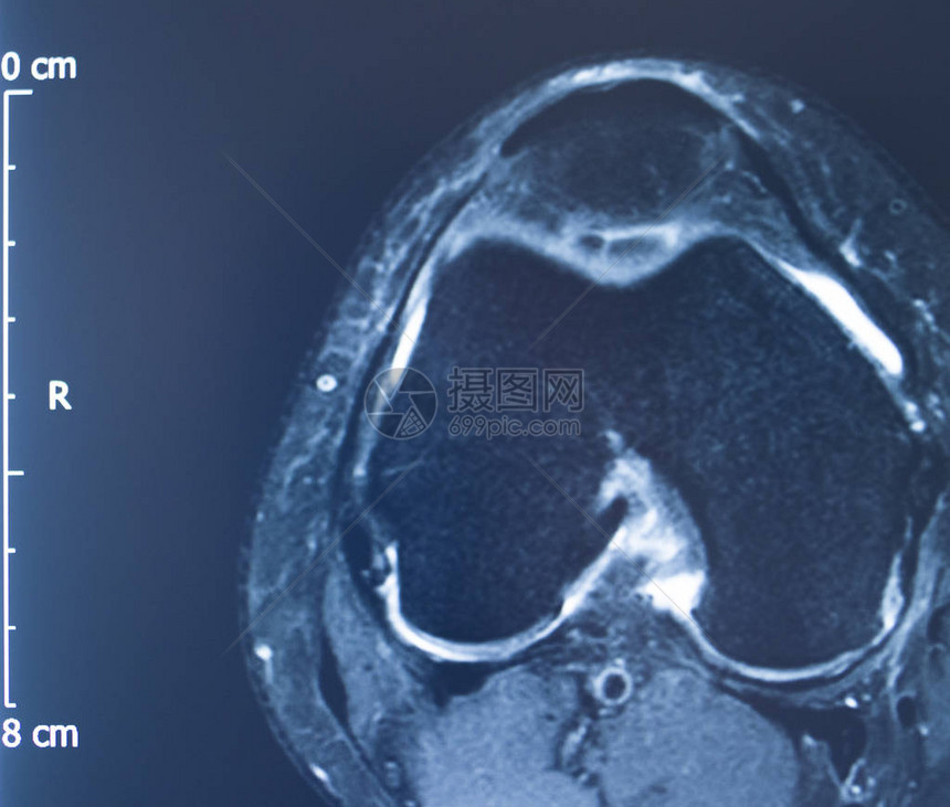 膝部运动受伤米克2级撕裂磁共振成像矫图片