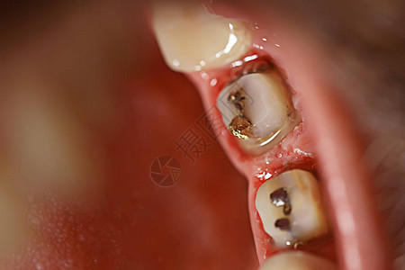 牙缝牙科宏观牙齿口胶牙图片
