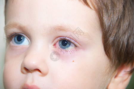 儿童眼结膜炎眼科疾病红眼睛血管在眼中爆背景图片