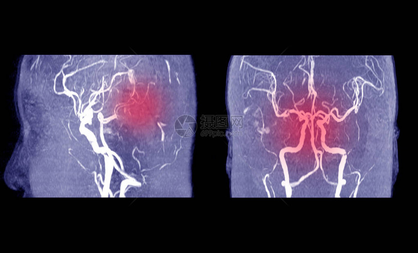 MRA脑或动脉磁共振血管造影与habd医生指出脑内血管异常医图片