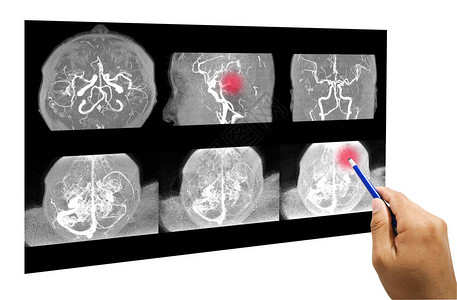 MRA脑或动脉磁共振血管造影与habd医生指出脑内血管异常医背景图片