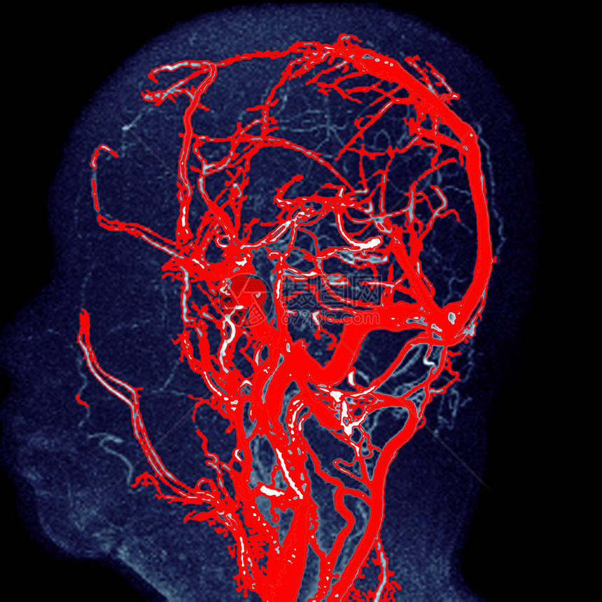 MRA脑骨髓3D外观显示常见的颈图片