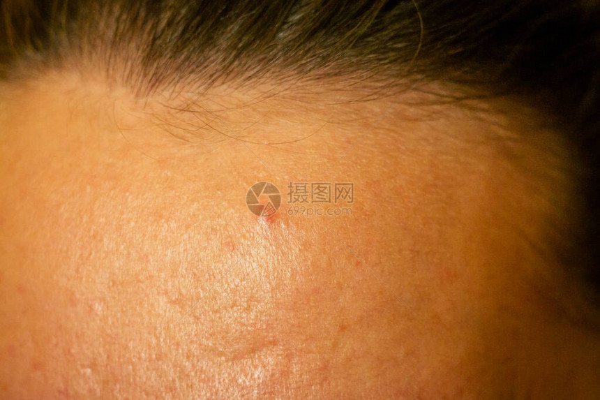 一名年轻女脸上的后阴囊伤疤和红发皮条图片