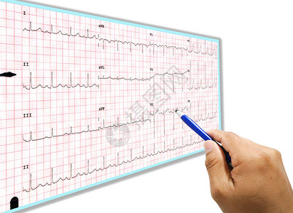 手医生点心电图打印输出图片