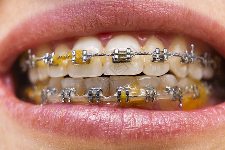 牙套紧的牙齿牙科护理照片女人笑得像奥多恩配饰图片