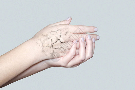 皮肤裂开的手皮肤皲裂皮肤干燥冬季护图片