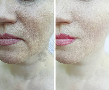 鼻唇沟妇女在治疗前后和治疗前背景