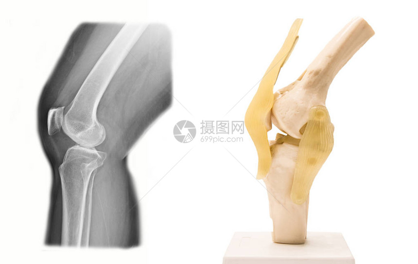 医学上人工膝盖结关模型和图片