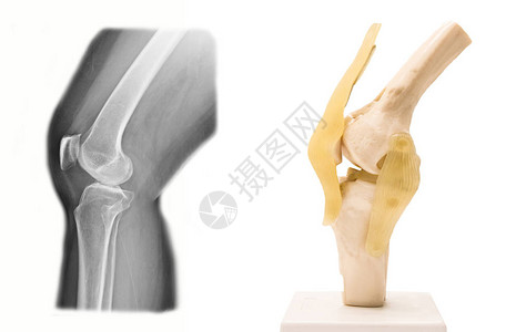 医学上人工膝盖结关模型和图片