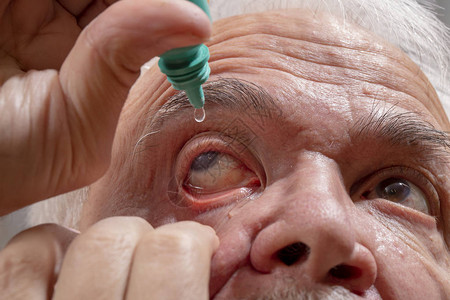 青光眼患者自行滴眼药水一位患有高清图片