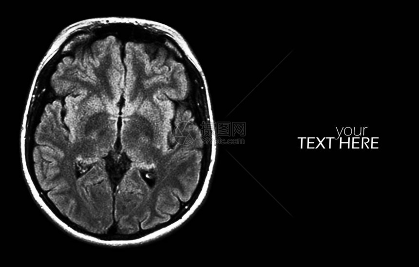 黑色大脑MRI扫描图片