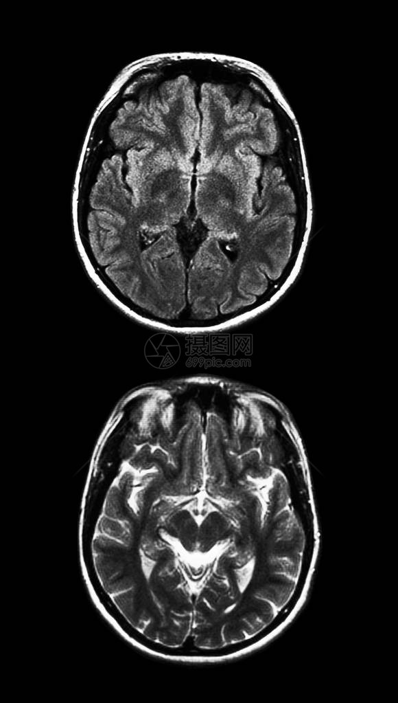 黑色大脑MRI扫描图片