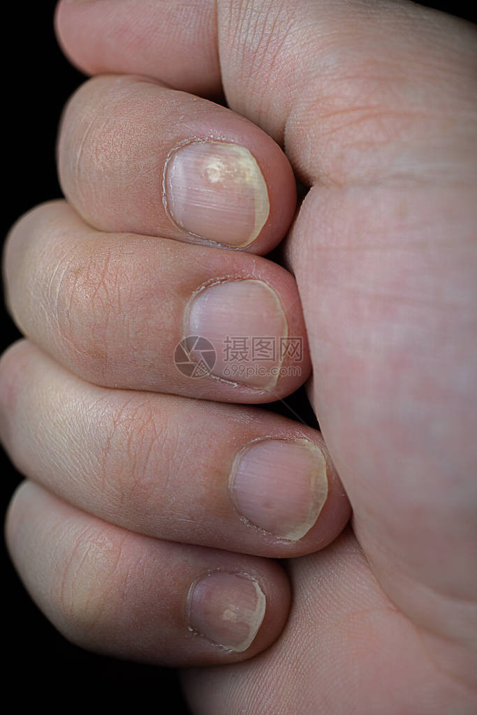 皮丝虫病是一种影响指甲和皮肤的自体免疫疾病在黑暗背景上紧贴Pso图片