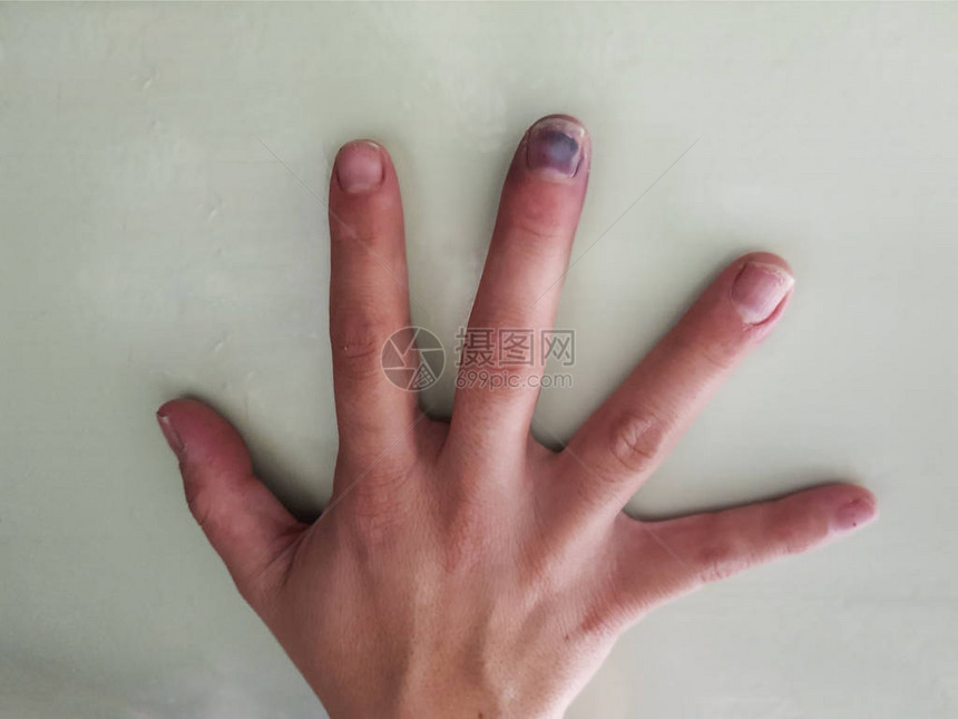 黑色受伤的指甲他右手的中指受伤了手指图片