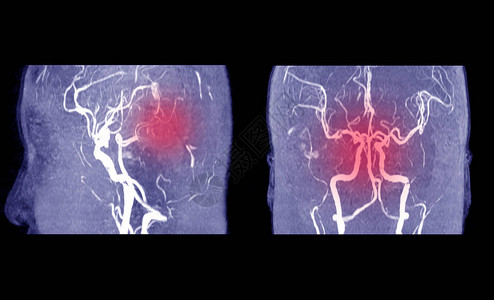 MRA脑或动脉磁共振血管造影与habd医生指出脑内血管异常医背景图片