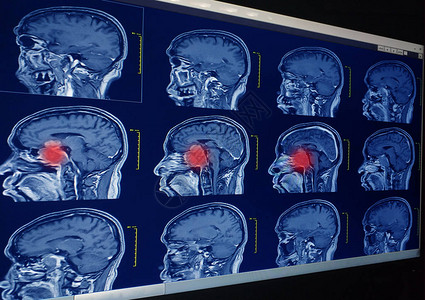 脑电磁共振成像MRI图片