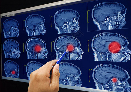 脑电磁共振成像MRI图片