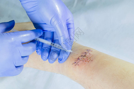 一名蓝手套医生检查腿部伤口用注射器注图片