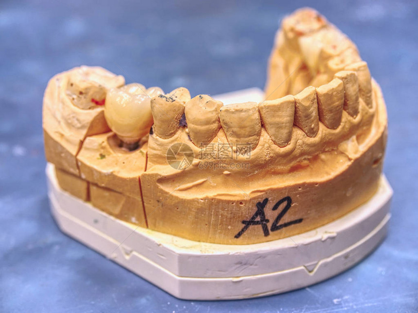 牙科实验室石膏模型上的人牙陶瓷和锆冠牙冠修复的图片